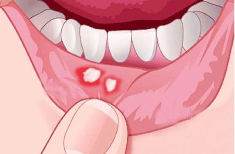 Hình ảnh bệnh nhân bị nhiệt miệng